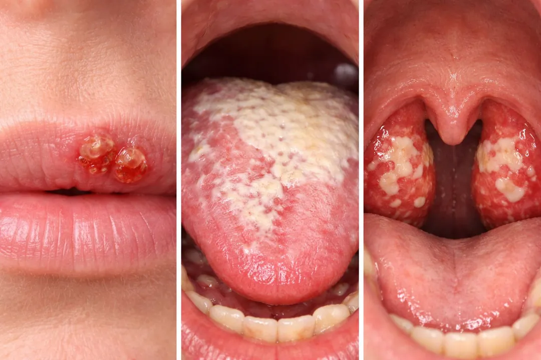 Imagem ilustrativa da imagem Alerta no Carnaval: Veja como o beijo pode transmitir doenças graves