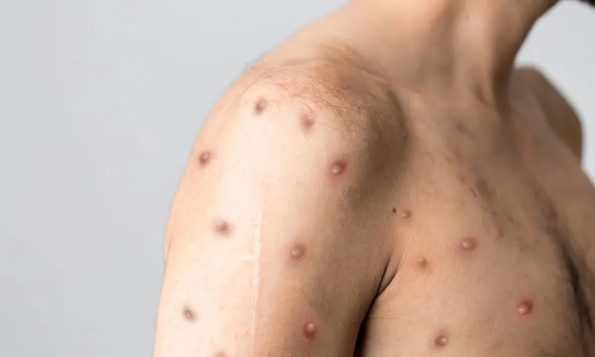 Imagem ilustrativa da imagem Bahia registra novo caso suspeito de Mpox