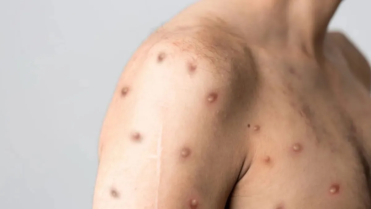 Já foram 55 casos registrados este ano no Brasil