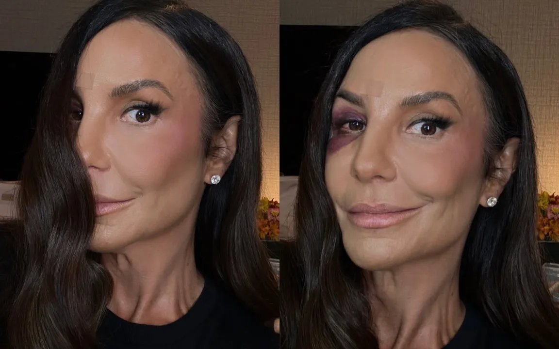 A artista contou detalhes sobre o procedimento delicado