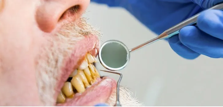 Bactérias presentes na boca podem atingir a corrente sanguínea