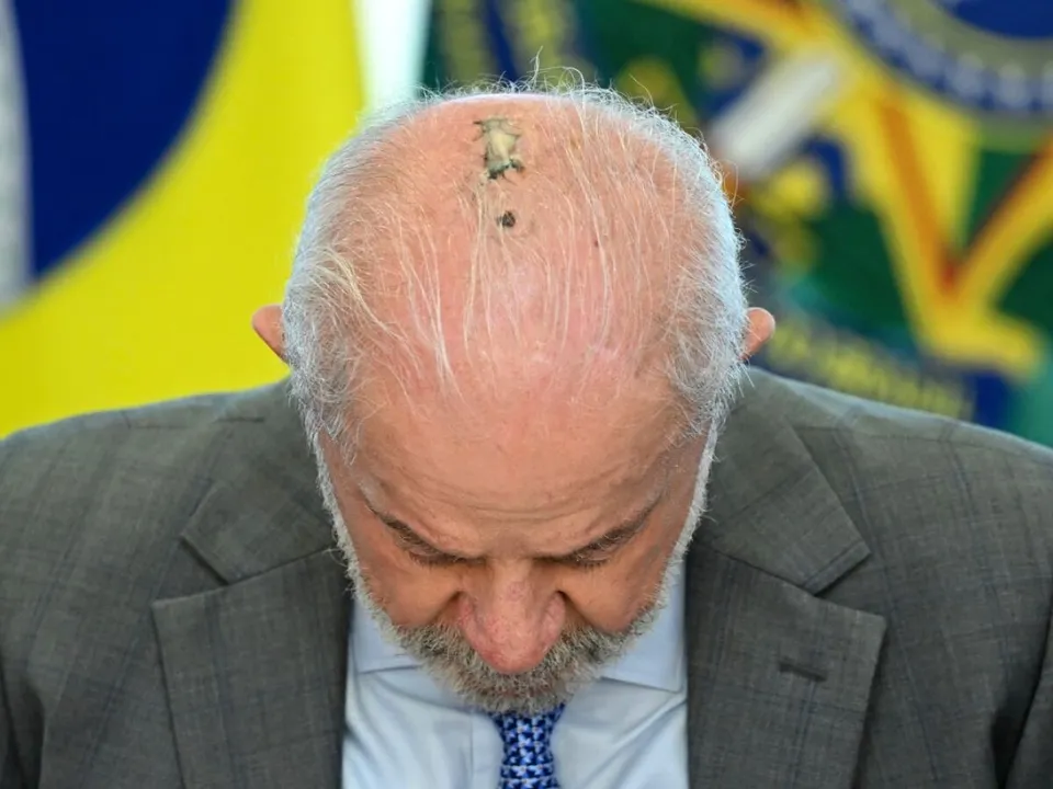 Lula estava com câncer de pele na cabeça