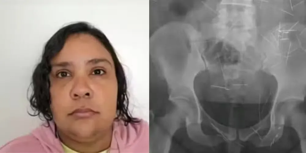 Amanda Maria e o exame de raio-x com as agulhas