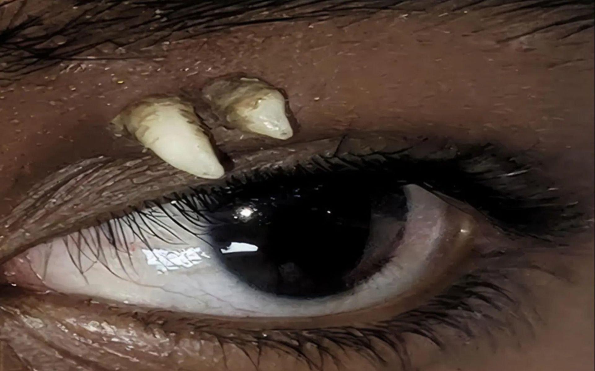 Jovem descobre dente raro crescendo acima do olho após fazer exame