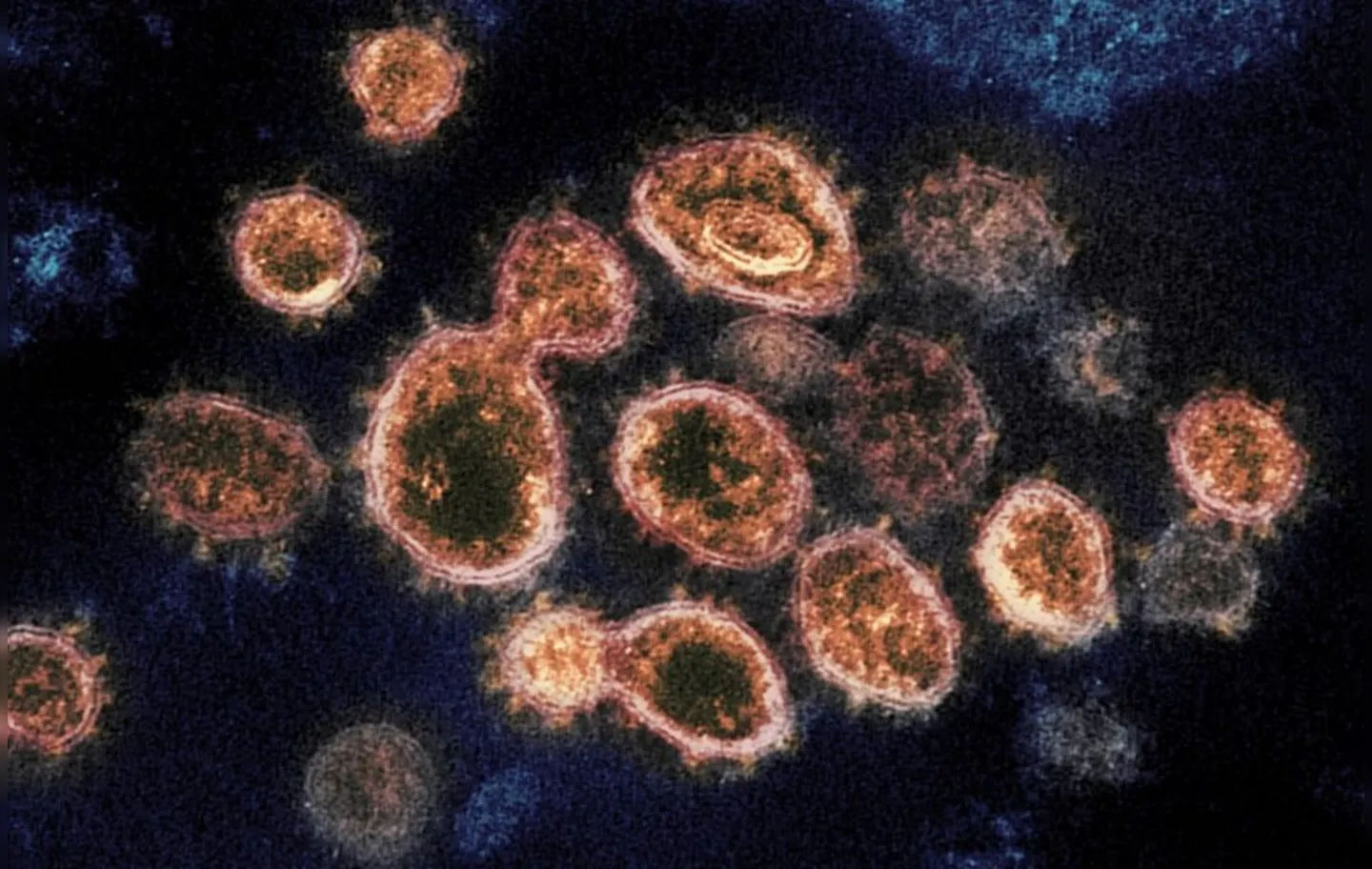Imagens de microscópio mostram partículas do coronavírus que causam a Covid-19 retiradas de um paciente nos EUA