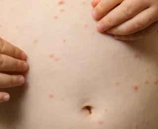 OMS e Unicef alertam para explosão de casos de sarampo no mundo