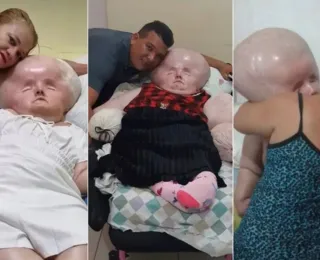 Brasileira com hidrocefalia completa 29 anos de idade
