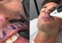 Homem retira bigode para tatuar bigode no lugar; veja o resultado
