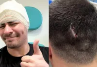 Thiago Martins sofre acidente em gravação e leva 6 pontos na cabeça