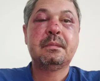 Brasileiro é agredido durante ataque xenofóbico em Portugal