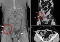 Homem sofre acidente de moto e testículo vai parar no abdômen