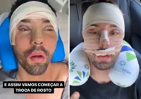 "Não aguentava mais ser chamado de feio", diz Rico pós cirurgia facial