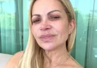 Solange Almeida tem lesão na voz após uso de cigarro eletrônico