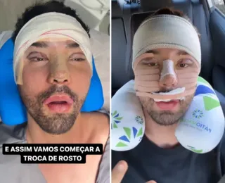 "Não aguentava mais ser chamado de feio", diz Rico pós cirurgia facial