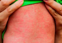 Brasil registra 1º caso de sarampo importado desde 2022