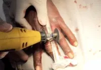 Bombeiros retiram anel preso há um mês em dedo de homem; VÍDEO