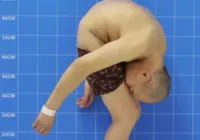 Homem 'dobrado' faz cirurgia e consegue andar ereto pela 1ª vez