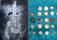 Homem engole 39 moedas e 37 ímãs para levantar mais peso na academia