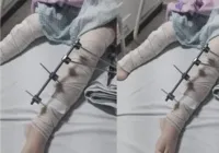 Médicos colocam pinos em perna errada de menina de 6 anos na Paraíba