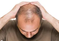 Pessoas com alopecia podem ganhar cirurgia gratuita pelo SUS