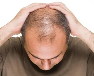 Pessoas com alopecia podem ganhar cirurgia gratuita pelo SUS