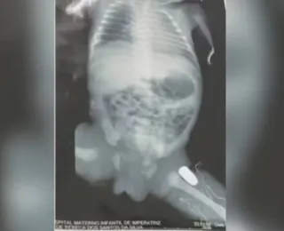 Bebê baleada na barriga da mãe passa por cirurgia para retirar bala