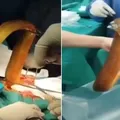 Homem passa por cirurgia após enfiar enguia viva de 60cm no ânus imagem