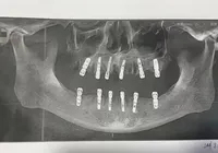 Homem morre após passar por cirurgia em que extraiu 23 dentes