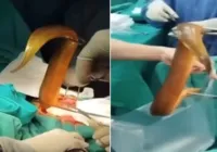 Homem passa por cirurgia após enfiar enguia viva de 60cm no ânus imagem