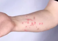 OMS declara mpox como emergência internacional de saúde pública
