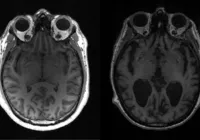 Sintoma de Alzheimer pode aparecer aos 40 anos, diz estudo