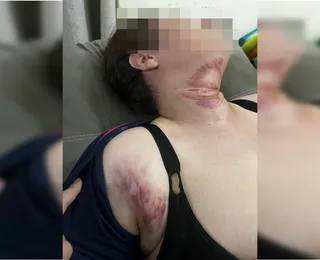 Fio solto corta pescoço e derruba mulher de garupa de moto