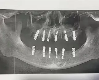 Homem morre após passar por cirurgia em que extraiu 23 dentes