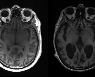 Sintoma de Alzheimer pode aparecer aos 40 anos, diz estudo