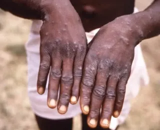 Varíola Mpox: Bahia confirma 38 casos e investiga nova variante