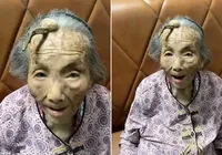 ‘Chifre do diabo’ cresce em testa de idosa de 107 anos