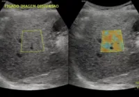 Clínica oferece exames gratuitos para pacientes com gordura no fígado