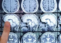 Dia Mundial do AVC: neurologista alerta para sintomas e prevenção