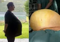 Homem descobre tumor de 27 kg após diagnóstico de obesidade