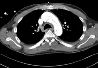 Perigoso? Homem rompe aorta durante masturbação e passa por cirurgia