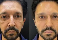 Ricardo Nunes faz procedimentos estéticos; veja antes e depois imagem
