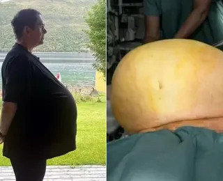 Homem descobre tumor de 27 kg após diagnóstico de obesidade