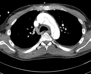 Perigoso? Homem rompe aorta durante masturbação e passa por cirurgia