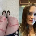 Jovem fica com cicatriz gigante após ser queimada por caravela imagem