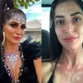 Sem filtro solar, global sofre queimaduras com maquiagem carnavalesca imagem