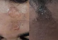 Após padre marcar cruz de cinzas em testas, fiéis relatam queimaduras imagem