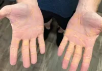 Colesterol 'vaza' das mãos de homem após dieta carnívora imagem
