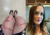 Jovem fica com cicatriz gigante após ser queimada por caravela imagem