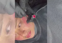Médicas alertam para riscos de tatuar blush e marca de biquini imagem
