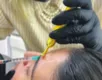 Cuidados no uso do botox evitam perda de dinheiro e problemas de saúde - Imagem